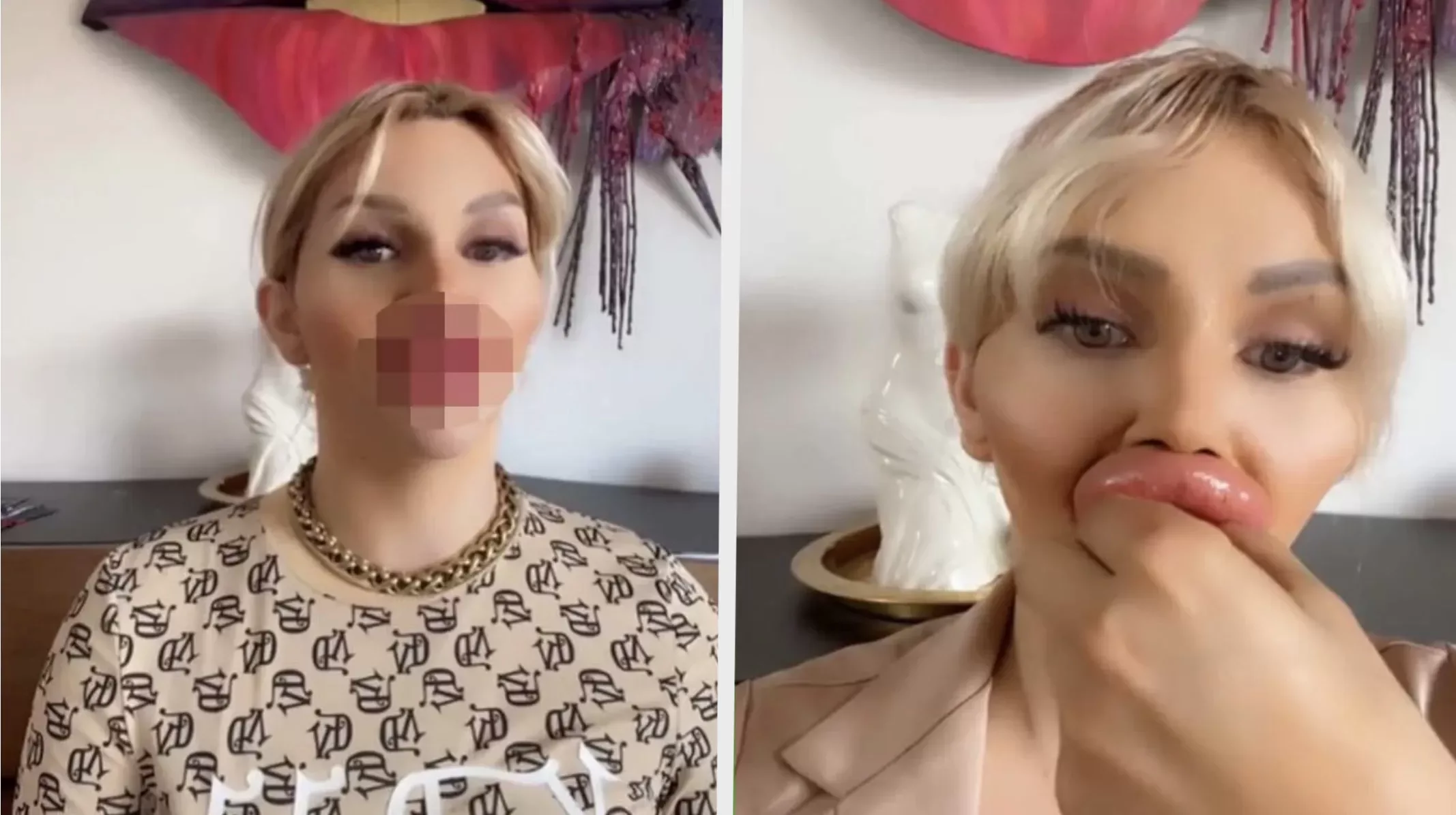 Vienna heeft XL-lip fillers maar klaagt nu dat ze niet goed kan eten en drinken