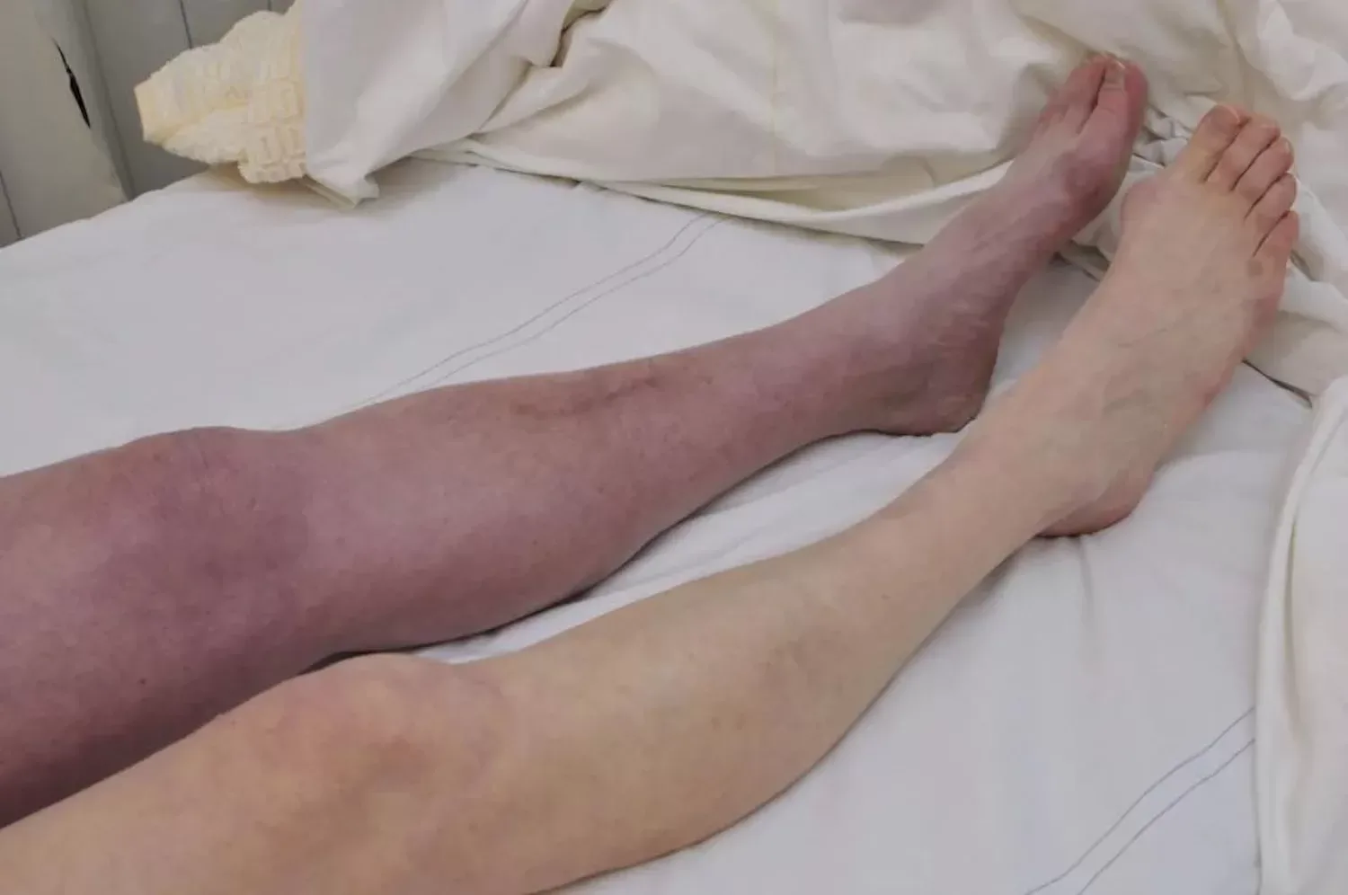 Zwelling of pijn in je been? Deze symptomen kunnen wijzen op trombose!