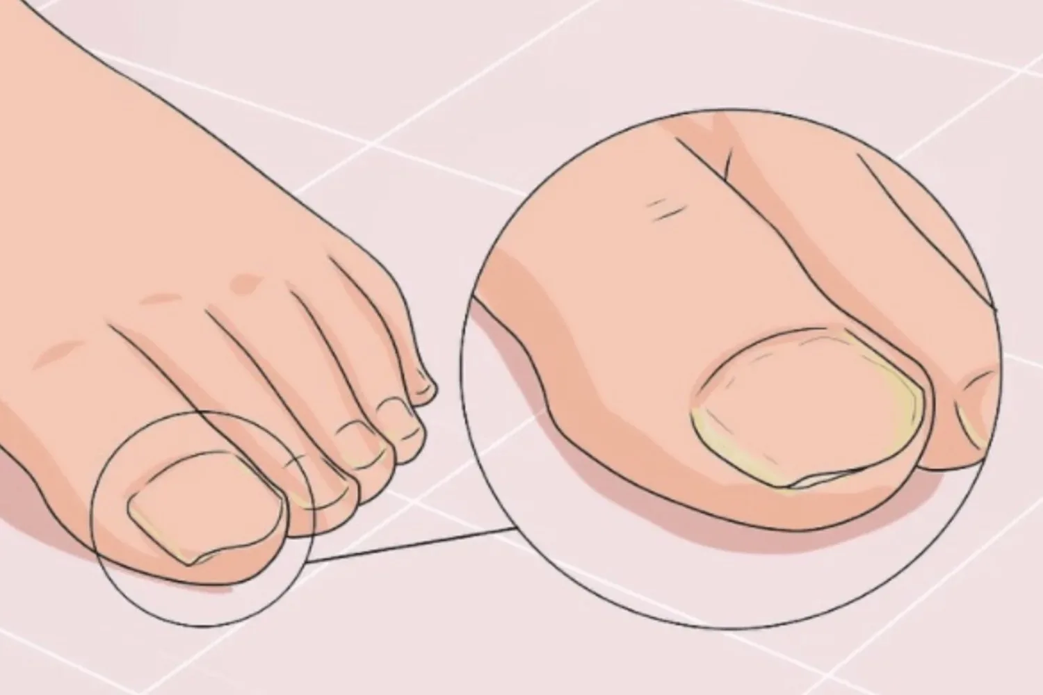 Je kunt voorgoed afrekenen met kalknagels. Dit middel is alles wat je nodig hebt