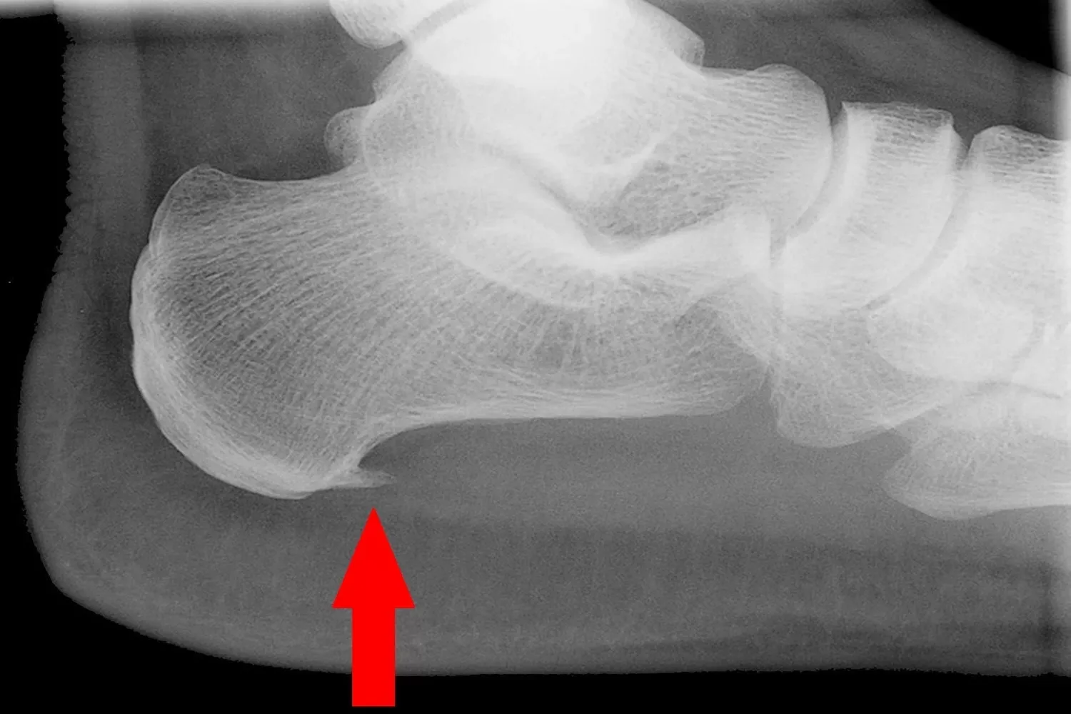 Hielspoor is vaak erg pijnlijk. Maar hoe kom je eraan en nog beter, hoe kom je er weer vanaf?! Zo dus!