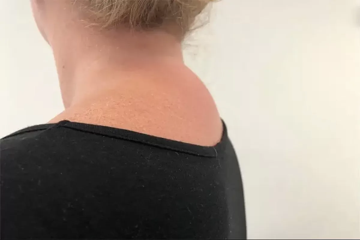 Last van een bobbel op de achterkant van je nek? Dan kun je hier last van hebben