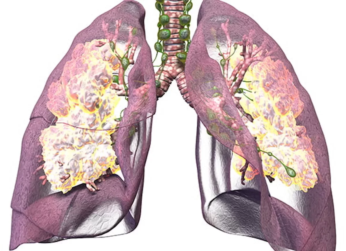 Longarts waarschuwt: “Dít moet iedereen weten over pulmonale hypertensie!”