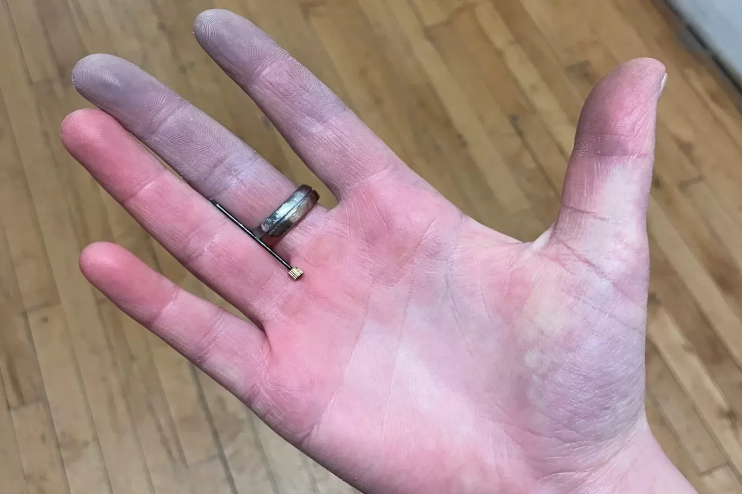 Deze onbekende ziekte veroorzaakt ‘lijkvingers’ (en dit zijn de symptonen)