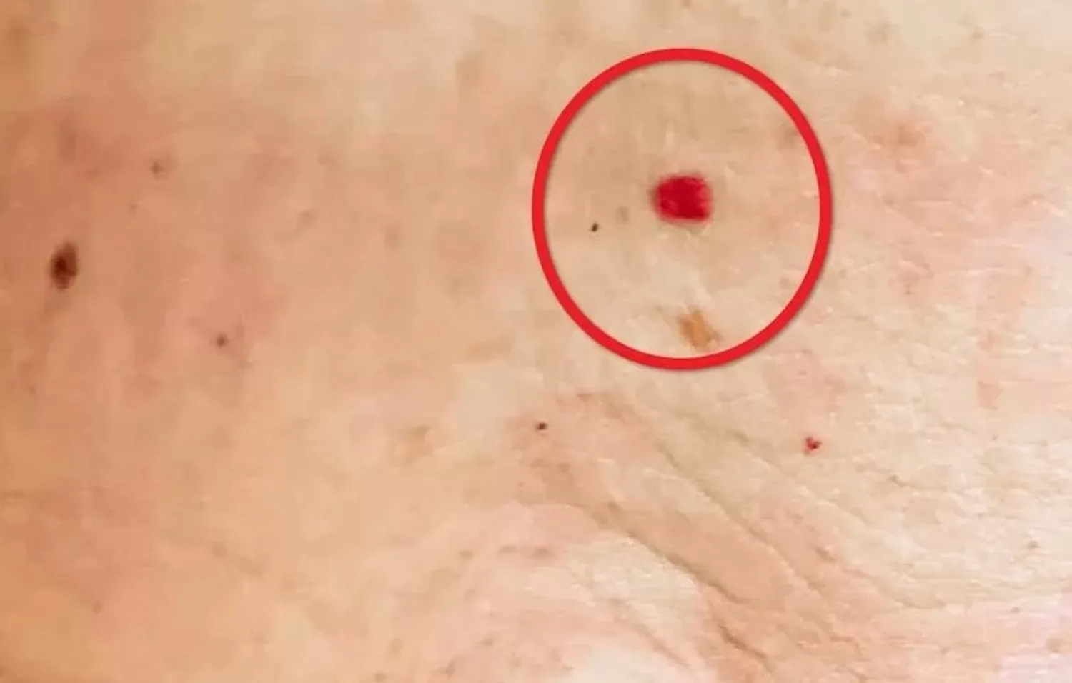 Last van kleine rode puntjes op je huid? Dit kunnen ze betekenen