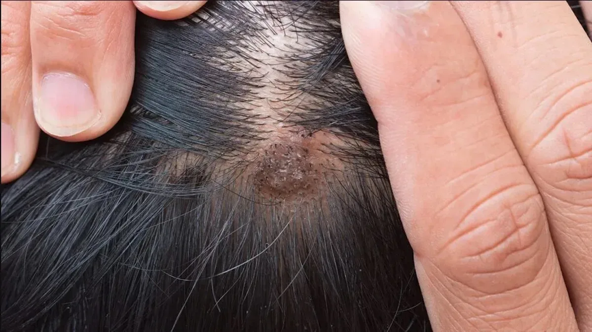 Heb jij ook regelmatig last van jouw hoofdhuid? Dit zou weleens de oorzaak kunnen zijn!