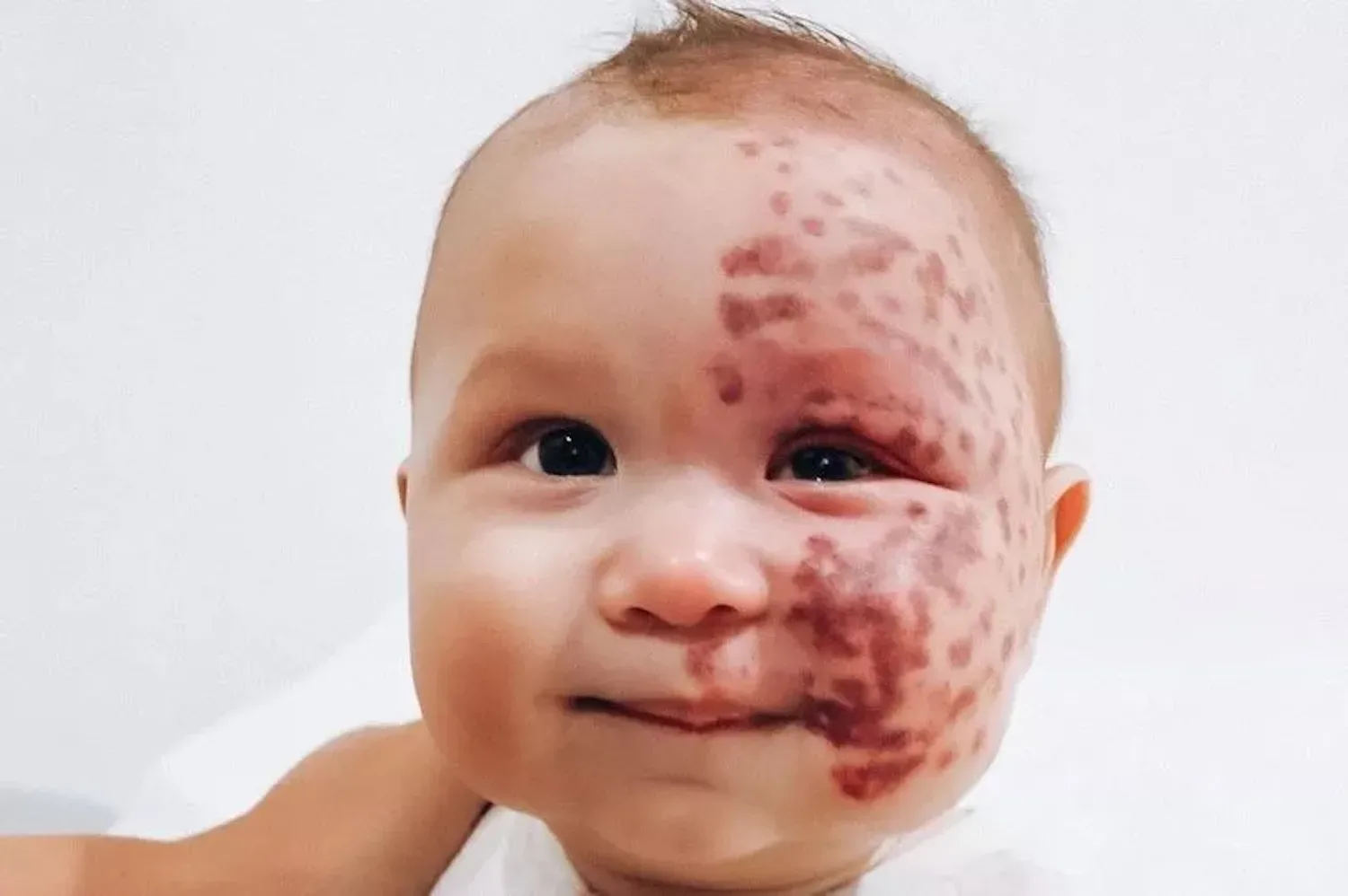 Moedervlek van baby weggelaserd: moeder krijgt zware kritiek (wat vind jij?)