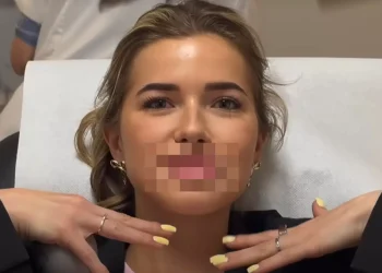 Jade Anna deelt beelden van haar cosmetische ingreep: ‘Wilde het natuurlijk houden…’