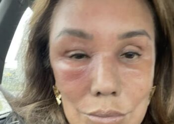 Grote zorgen om Patty Brard (70): met spoed naar het ziekenhuis, fans geschrokken van onheilspellende foto