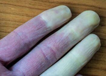 Artsen waarschuwen voor vingers die van kleur veranderen: dit moet je weten!