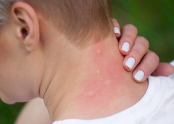 Mijn moeder gaf me dé truc om muggenbeten binnen één minuut te stoppen. Dit is hoe het werkt