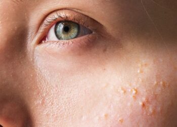 Arts geeft duidelijkheid: Dit is de reden achter vreemde witte bultjes op de edele delen