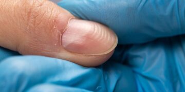 Geribbelde nagels? Dit kunnen ze verklappen over je gezondheid